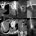 One-Time Lifetime Subscription for CT Guided Biopsy at www.ctbiopsy.com