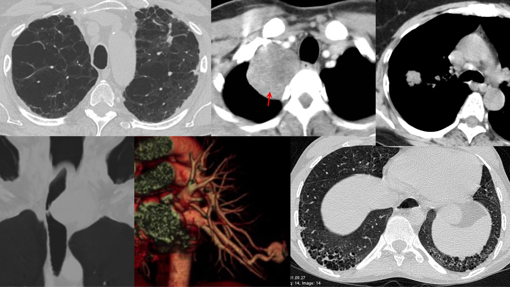 One-Time Lifetime Subscription for CT Chest Review at www.ctchestreview.com